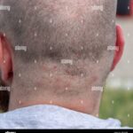 découvrez des remèdes efficaces pour soigner les boutons sur le cuir chevelu : astuces naturelles, conseils pour soulager les démangeaisons et prévenir leur apparition.