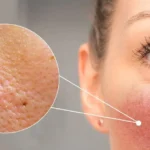 découvrez des remèdes efficaces contre la peau d'orange : astuces naturelles, conseils experts et solutions pour réduire la cellulite et retrouver une peau lisse et ferme.